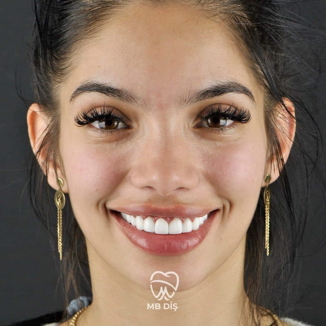 The smile of a patient whose treatment was completed at MB Diş Kliniği 2