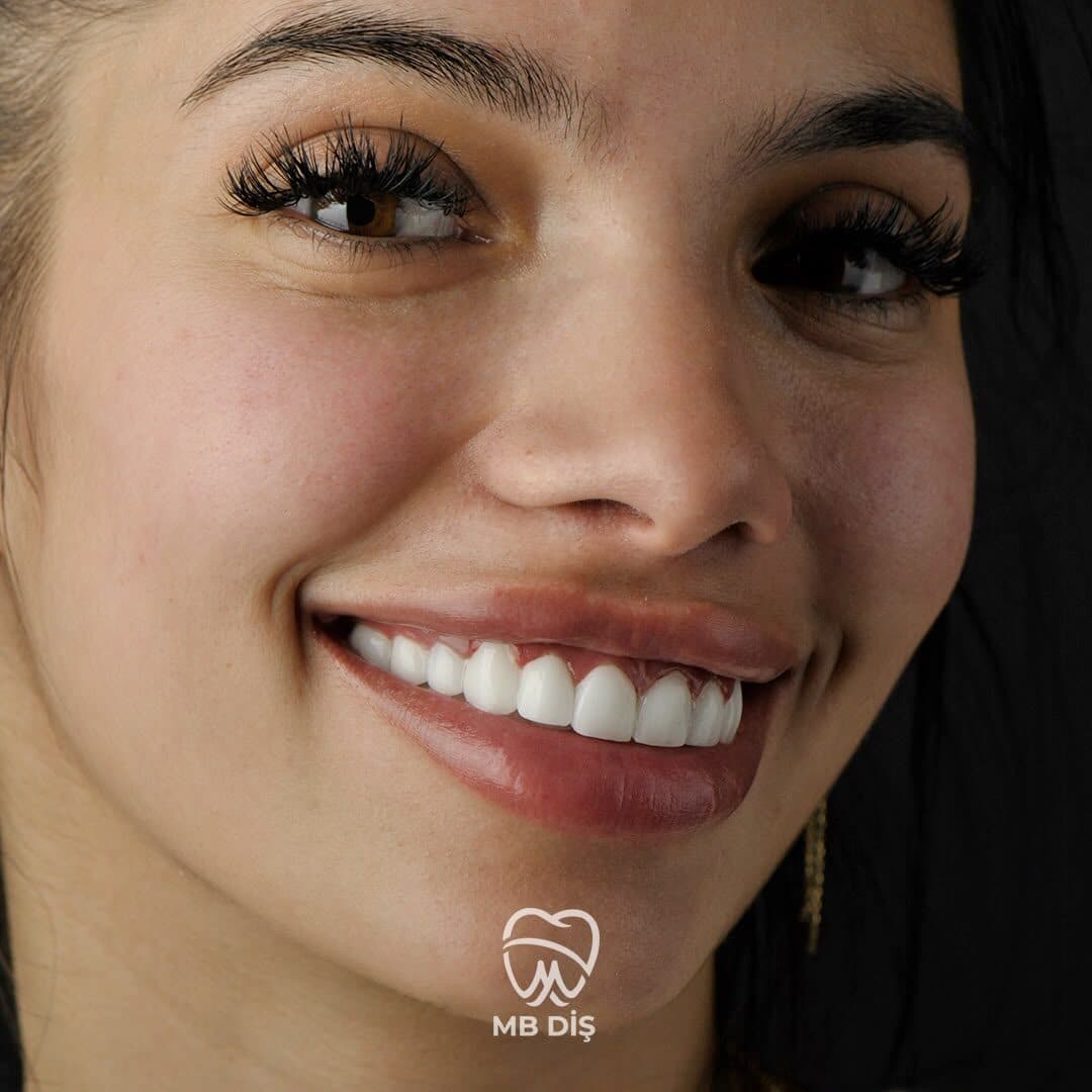The smile of a patient whose treatment was completed at MB Diş Kliniği 4