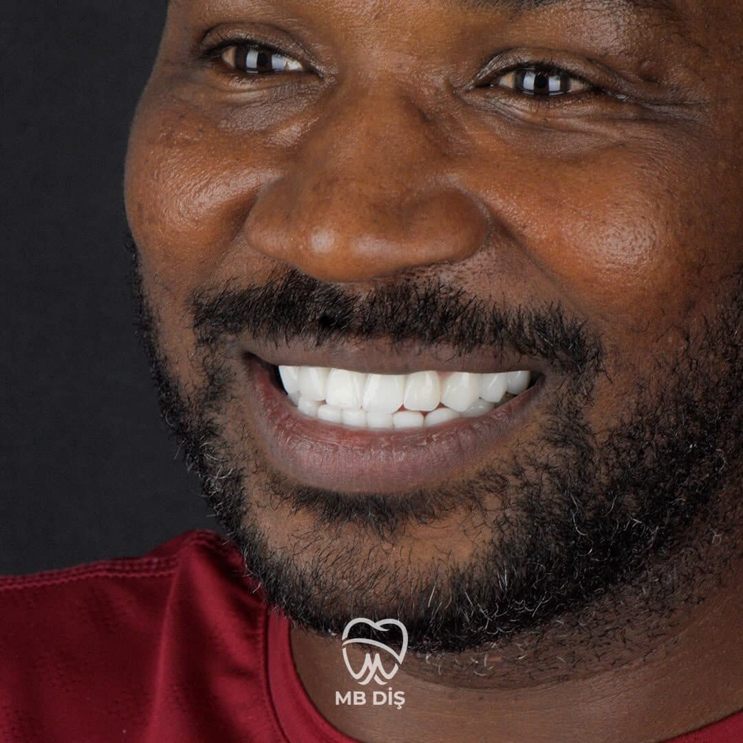 The smile of a patient whose treatment was completed at MB Diş Kliniği 7