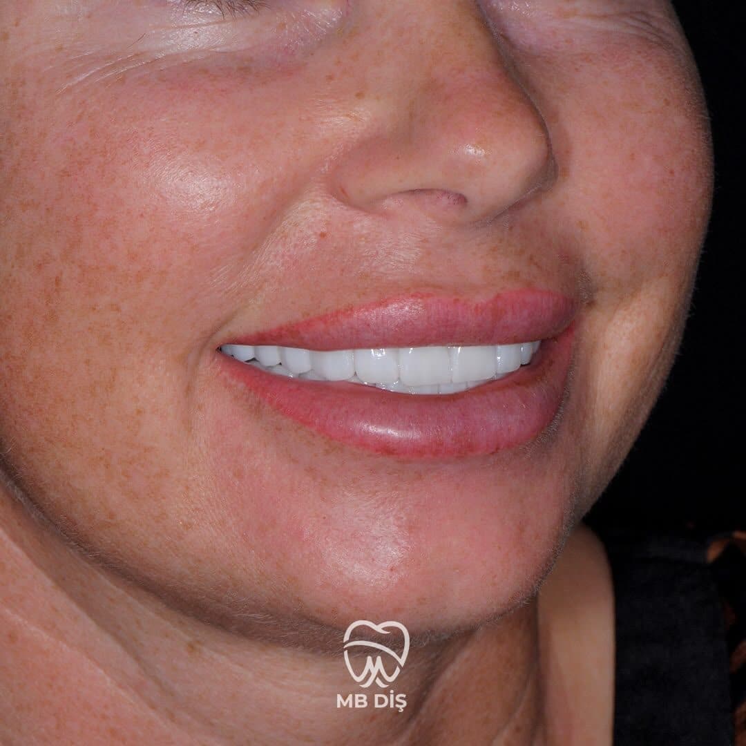 The smile of a patient whose treatment was completed at MB Diş Kliniği 8