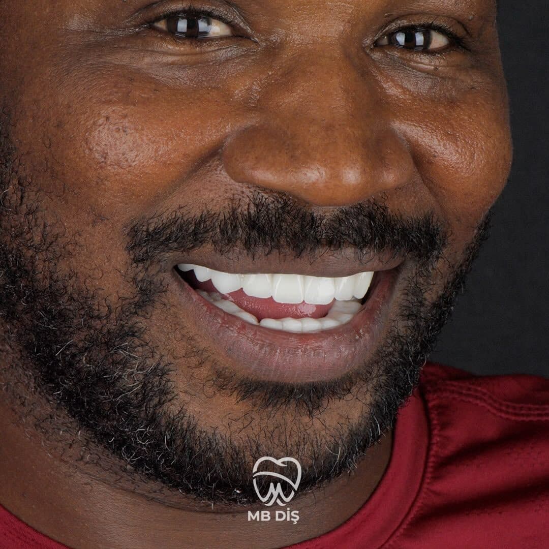 The smile of a patient whose treatment was completed at MB Diş Kliniği 9