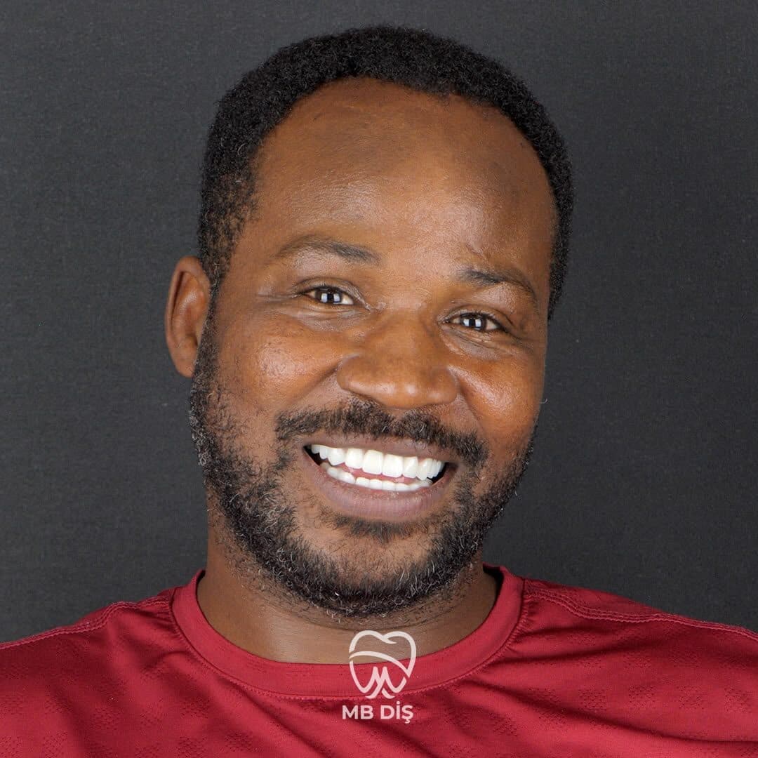 The smile of a patient whose treatment was completed at MB Diş Kliniği 10