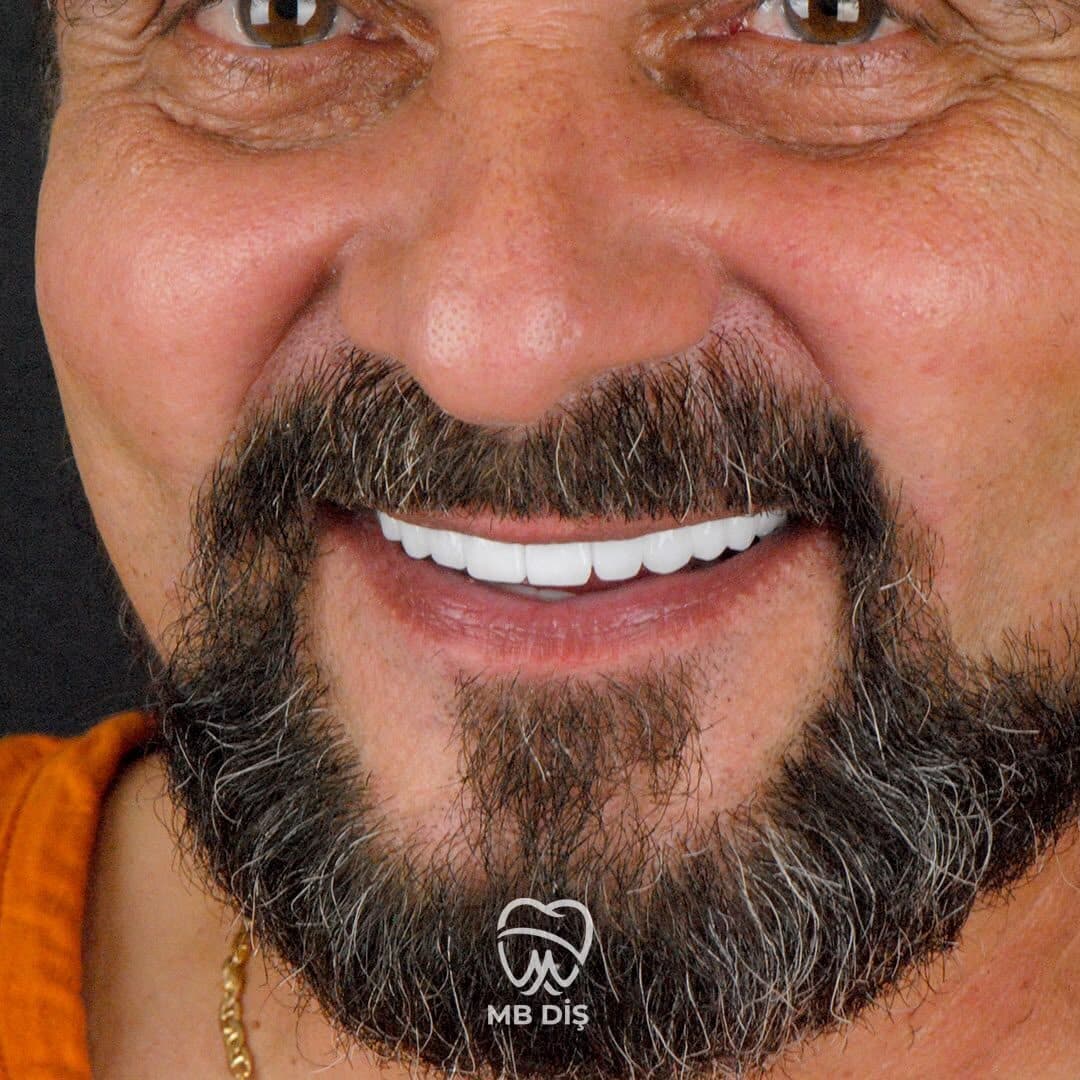 The smile of a patient whose treatment was completed at MB Diş Kliniği 12