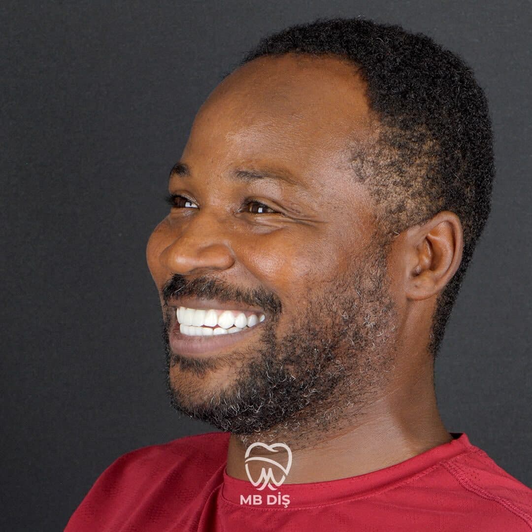 The smile of a patient whose treatment was completed at MB Diş Kliniği 13