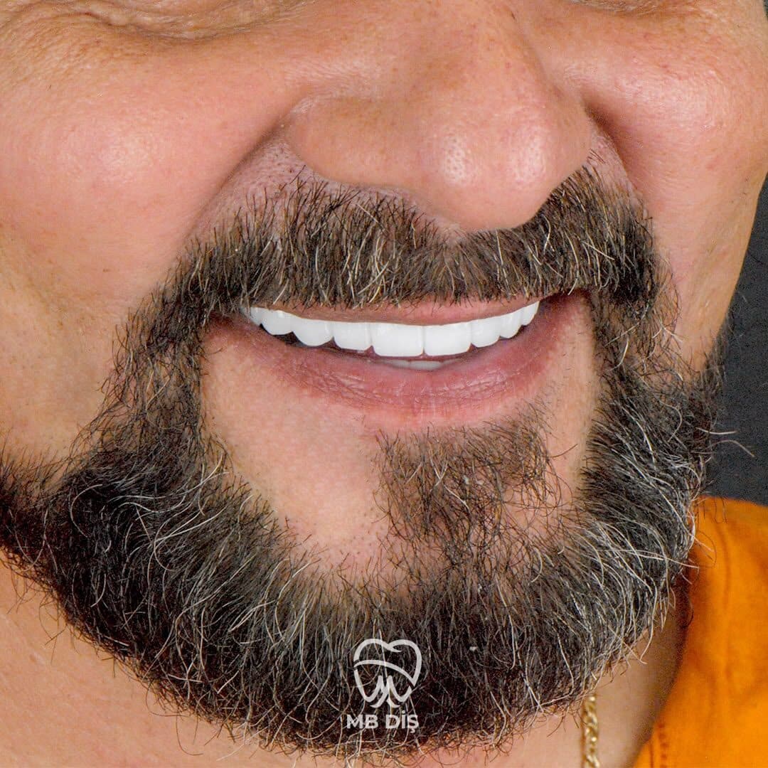The smile of a patient whose treatment was completed at MB Diş Kliniği 14