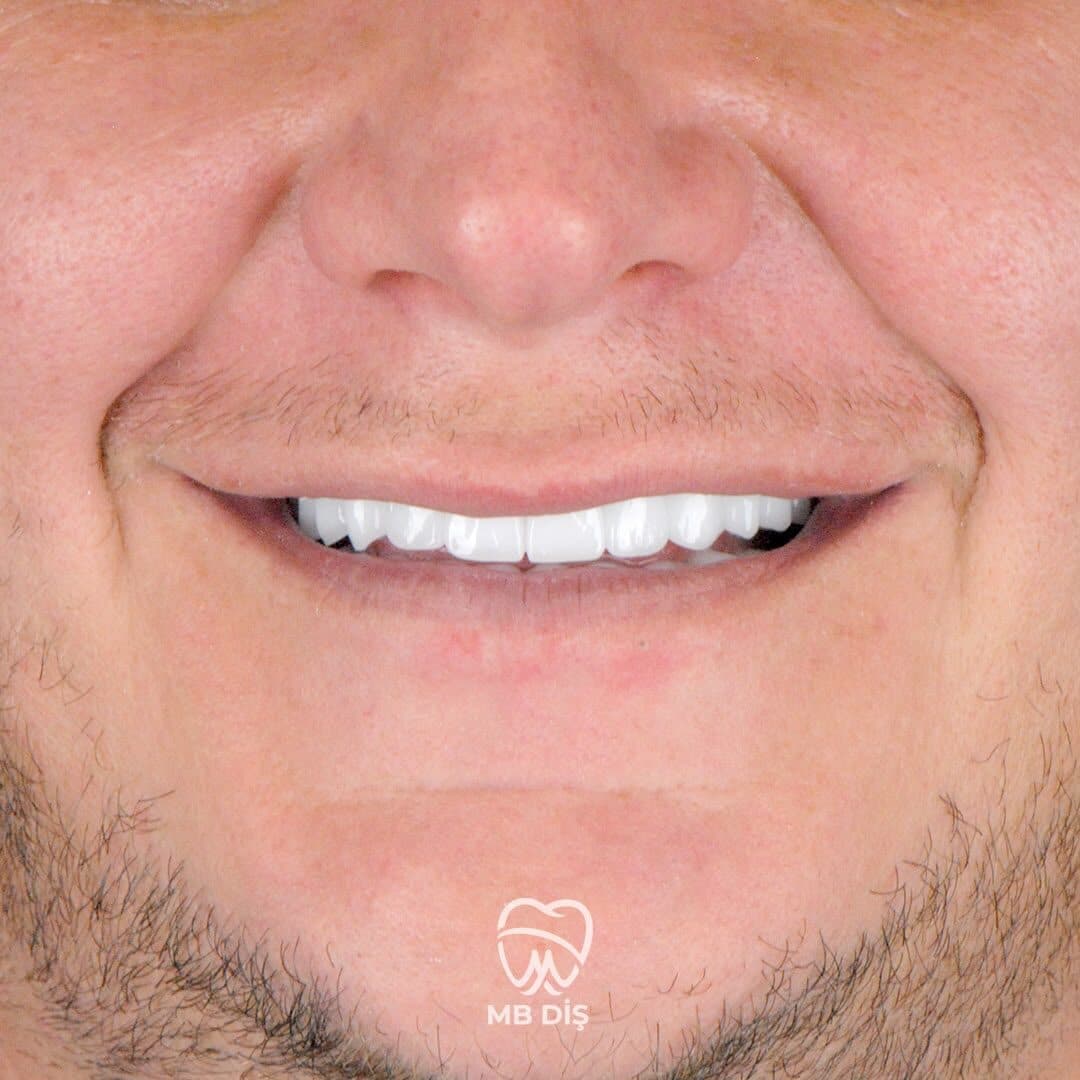 The smile of a patient whose treatment was completed at MB Diş Kliniği 15