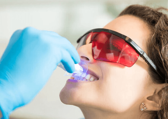 In-clinic light-activated teeth whitening