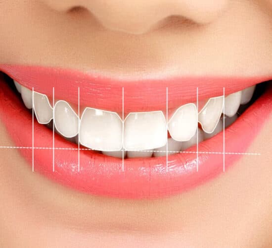 Planning tooth proportions for smile design