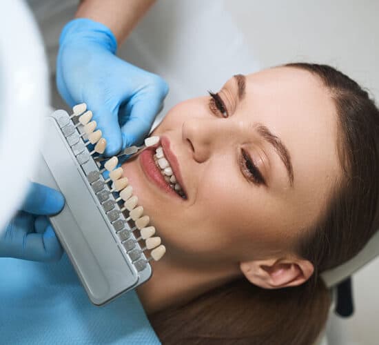 Using a shade guide to select tooth colour