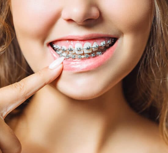 A smile treated with metal braces