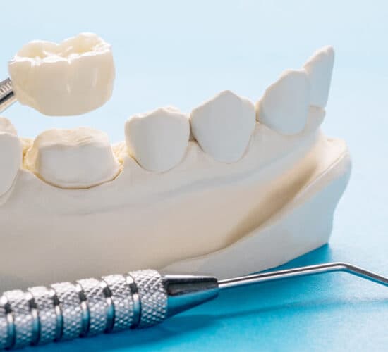 Single-tooth zirconia restoration model
